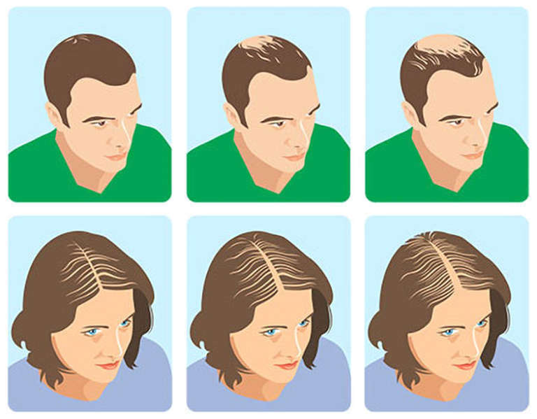 ᐅ Hvad tilbyder apoteket for androgenetisk alopeci? | iMed Guru